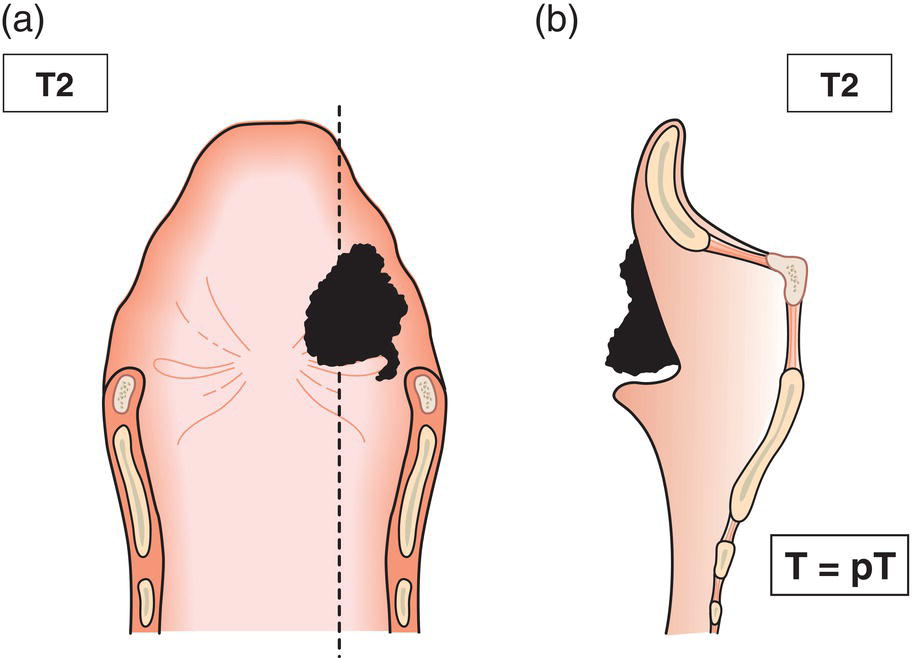 Schematic illustration of tumour invades mucosa of more than one adjacent subsite of supraglottis or glottis or region outside the supraglottis without fixation of the larynx.