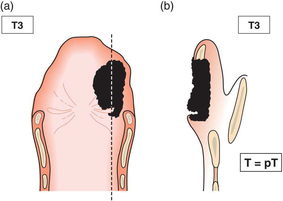 Schematic illustration of tumour limited to larynx with vocal cord fixation and invades any of the following: postcricoid area, pre‐epiglottic space, paraglottic space and inner cortex of thyroid cartilage.