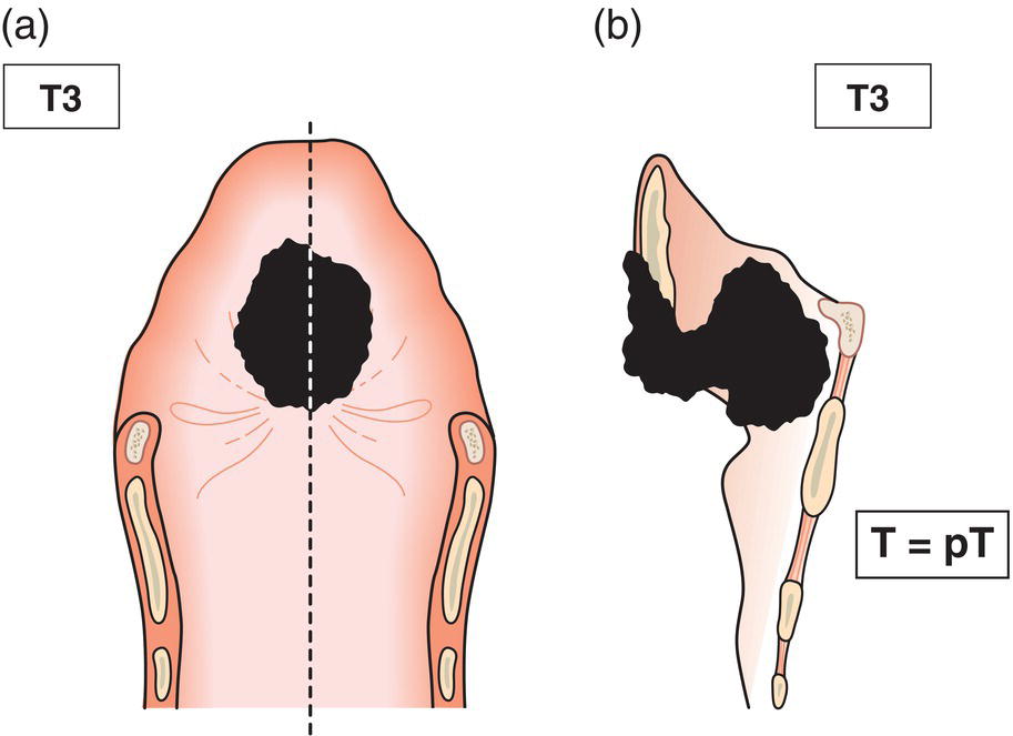 Schematic illustration of tumour limited to larynx with vocal cord fixation and invades any of the following: postcricoid area, pre‐epiglottic space, paraglottic space and inner cortex of thyroid cartilage.