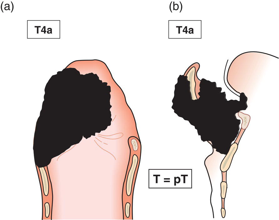 Schematic illustration of tumour invades through the thyroid cartilage and invades tissues beyond the larynx.