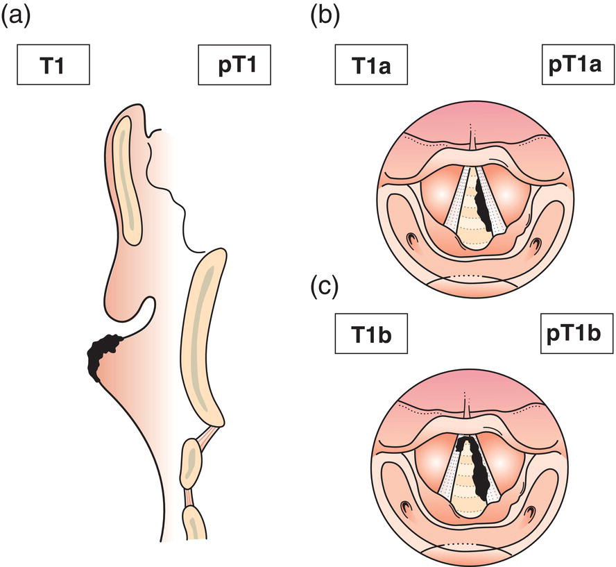 Schematic illustration of tumour limited to vocal cord with normal mobility.