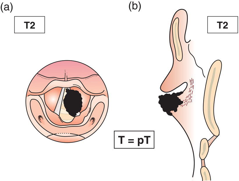 Schematic illustration of tumour extends to supraglottis and subglottis, and with impaired vocal cord mobility.