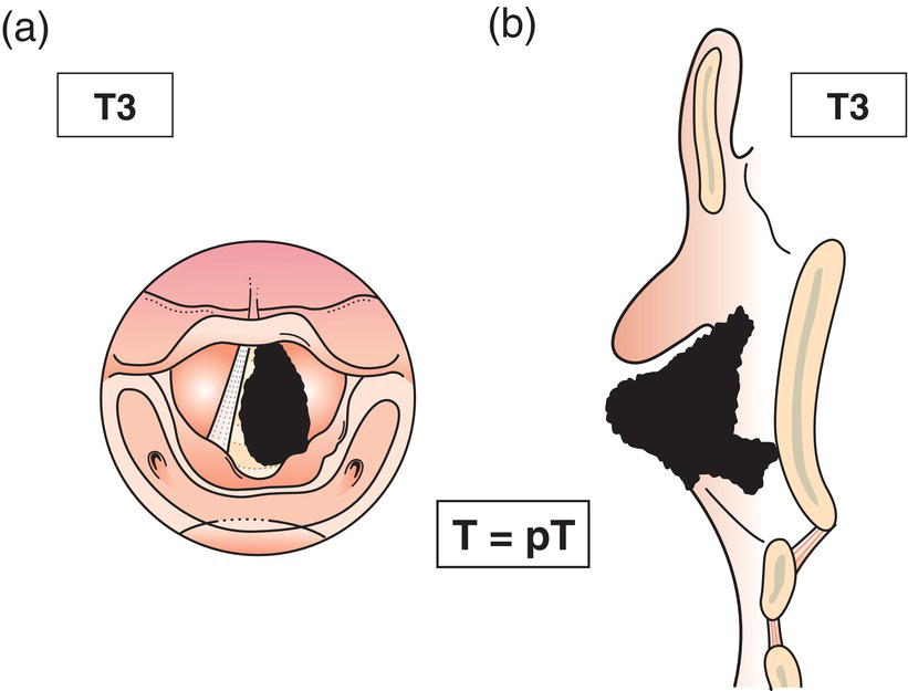 Schematic illustration of tumour limited to larynx with vocal cord fixation and invades paraglottic space, and inner cortex of the thyroid cartilage.