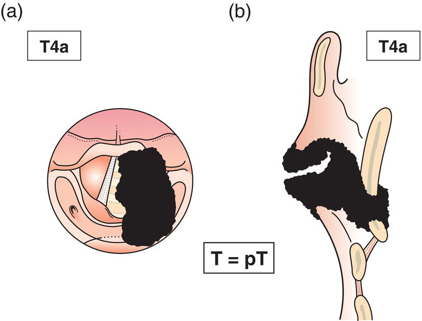 Schematic illustration of tumour invades through the outer cortex of the thyroid cartilage, and invades tissues beyond the larynx.