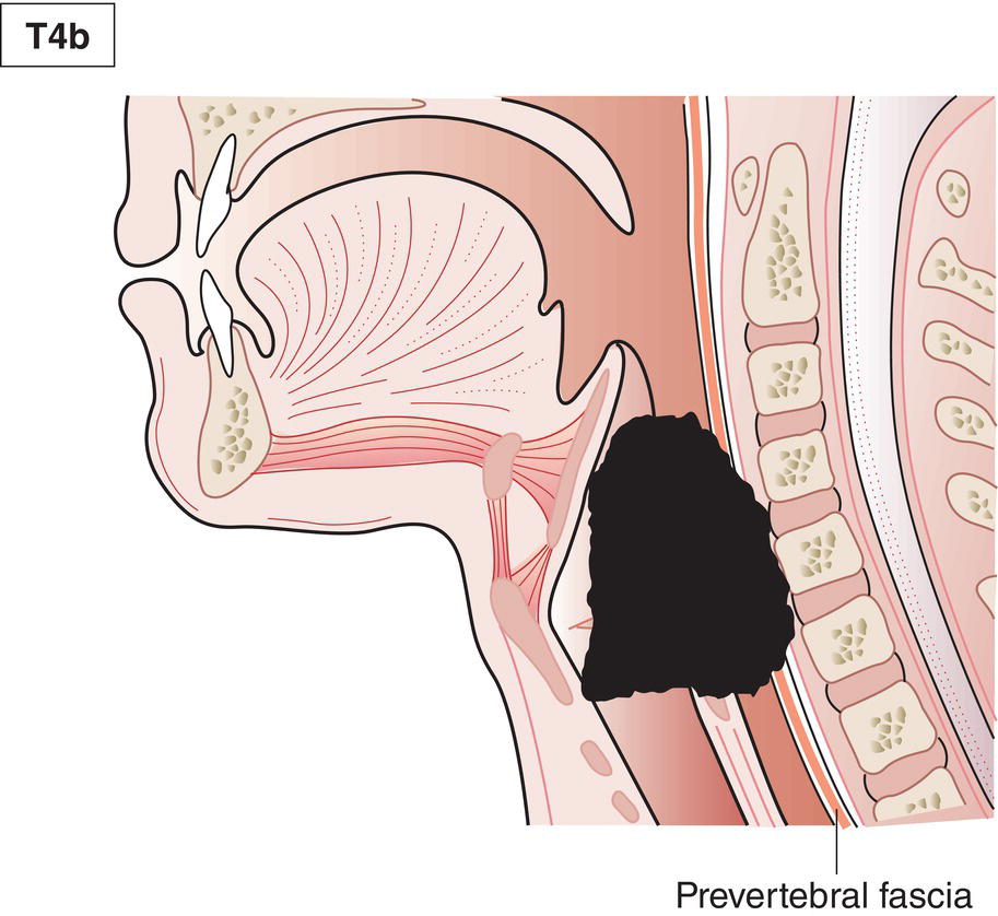 Schematic illustration of tumour invades prevertebral space, encases carotid artery, or mediastinal structures.