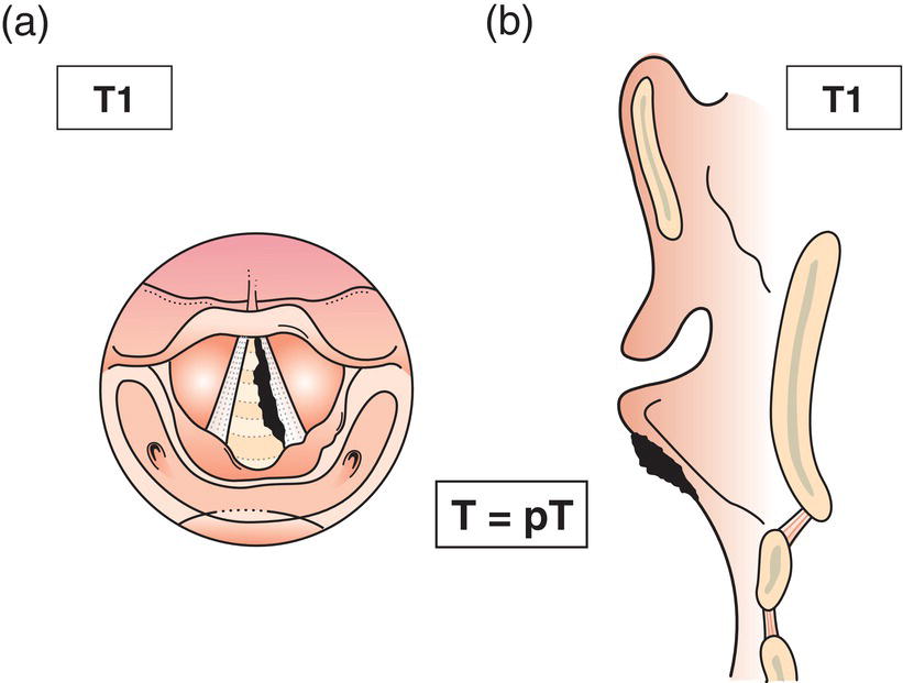 Schematic illustration of tumour limited to subglottis.