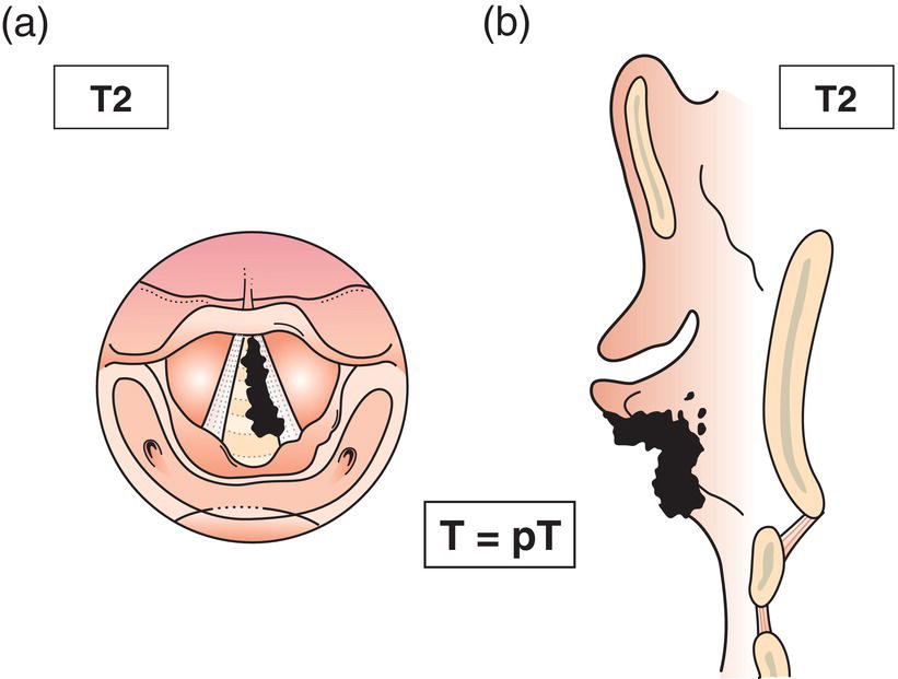 Schematic illustration of tumour extends to vocal cord(s) with normal or impaired mobility.