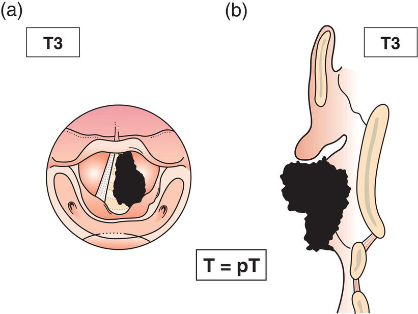 Schematic illustration of tumour limited to larynx with vocal cord fixation.