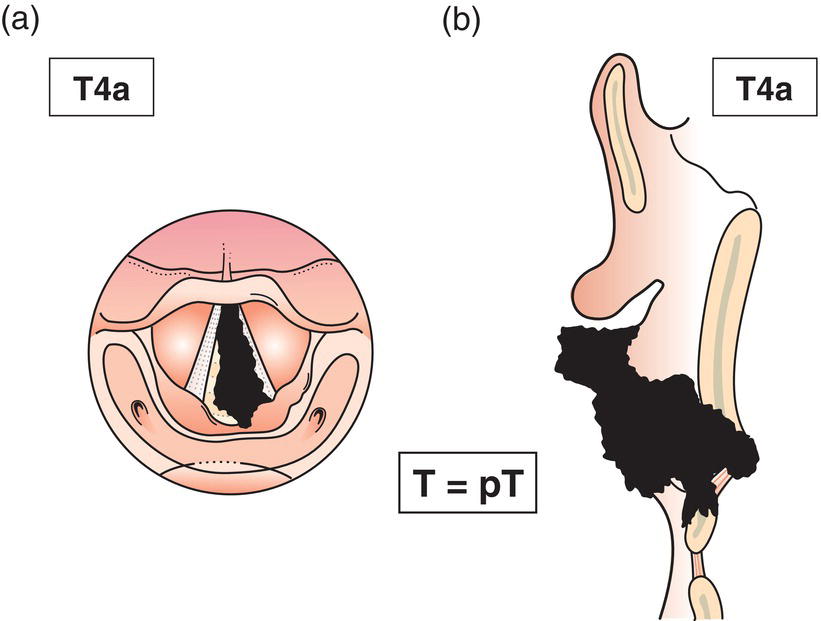 Schematic illustration of tumour invades cricoid or thyroid cartilage and invades tissues beyond the larynx, e.g., trachea, soft tissues of neck including deep/extrinsic muscle of tongue, strap muscles, thyroid, oesophagus.