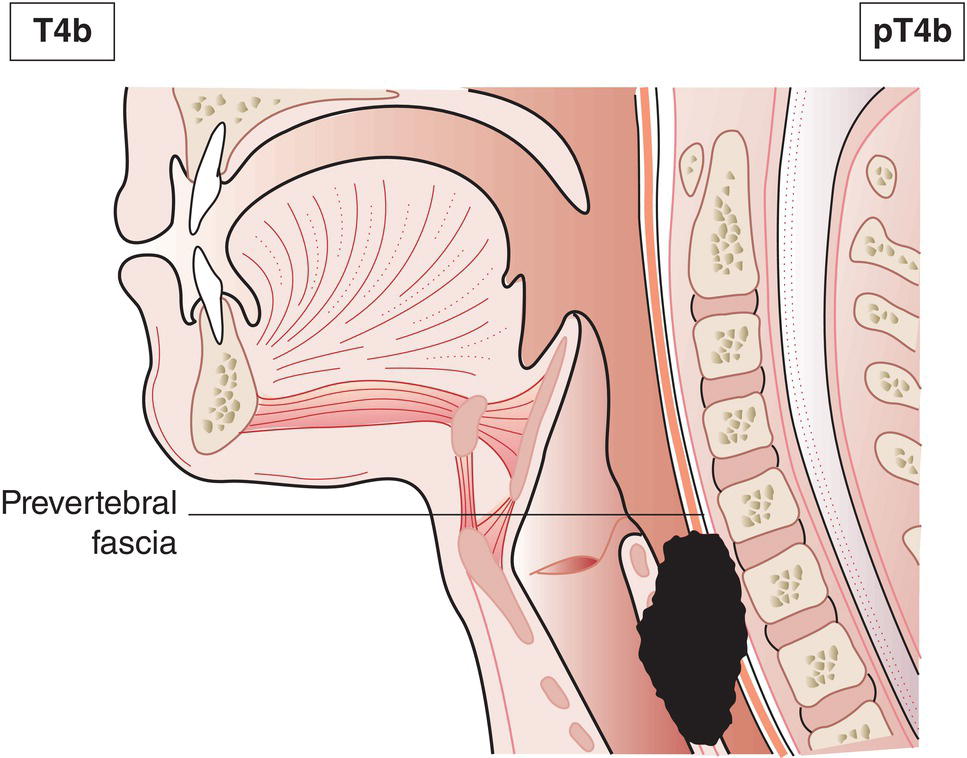 Schematic illustration of tumour invades prevertebral space, mediastinal structures, or encases carotid artery.