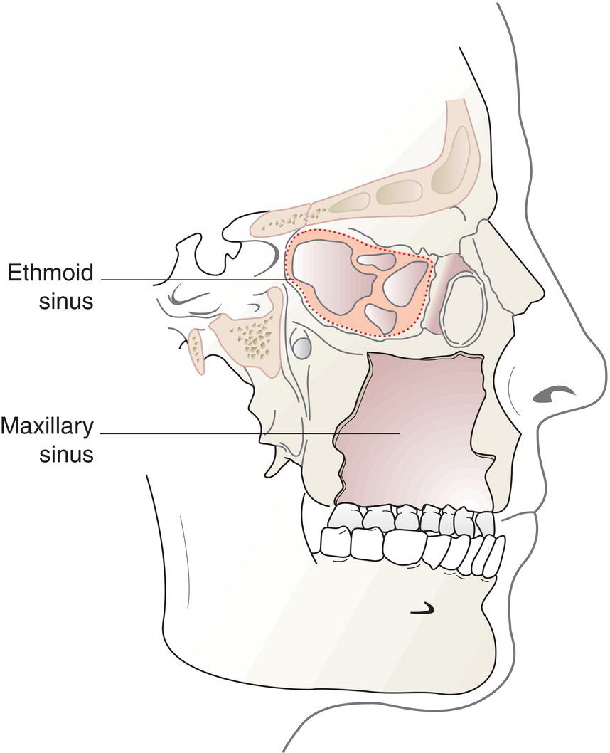 Schematic illustration of Maxillary Sinus and Ethmoid Sinus.