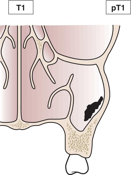 Schematic illustration of tumour limited to the mucosa with no erosion or destruction of bone.