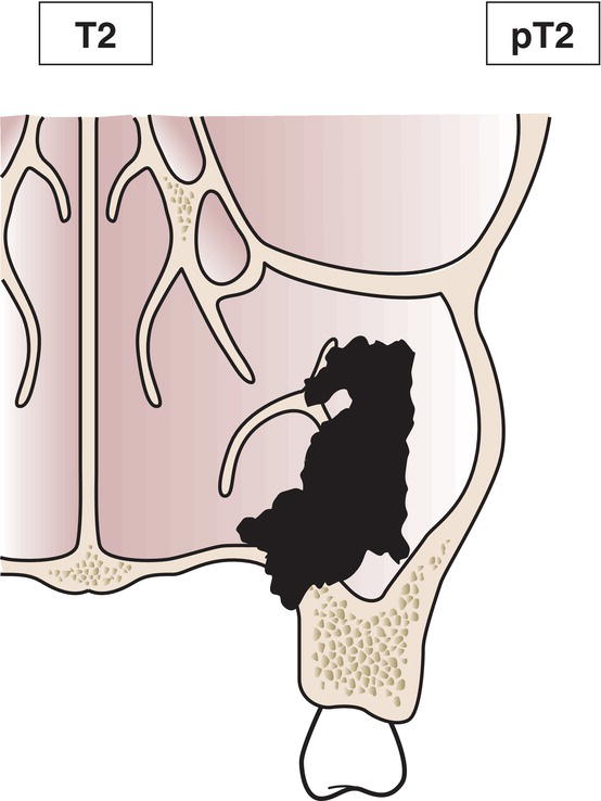 Schematic illustration of tumour causing bone erosion or destruction, including extension into the hard palate and middle nasal meatus, except extension to posterior wall of
maxillary sinus and pterygoid plates.