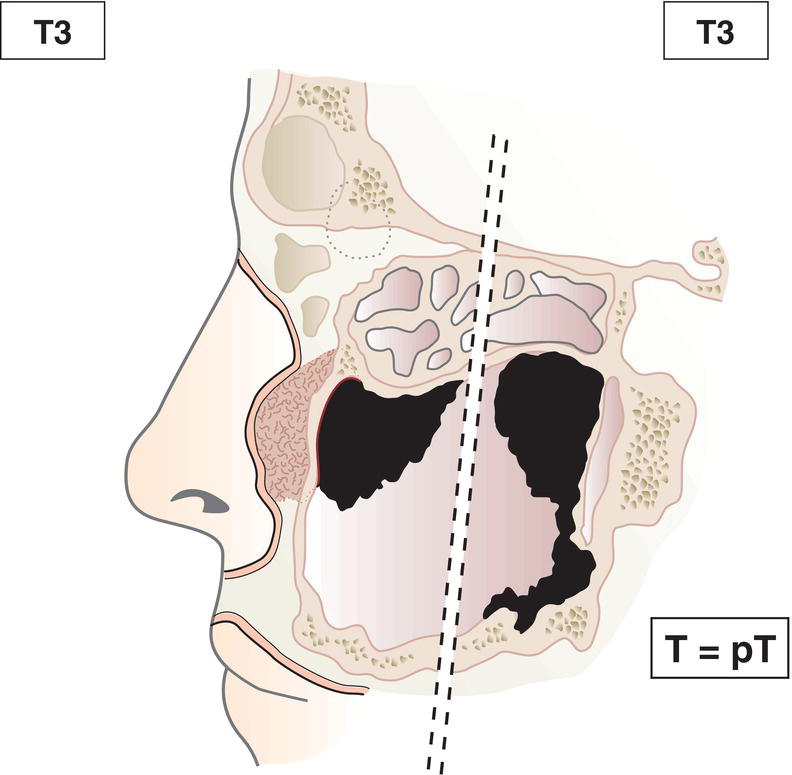 Schematic illustration of tumour invades any of the following: bone of posterior wall of maxillary sinus, subcutaneous tissues, floor or medial wall of orbit, pterygoid fossa, ethmoid sinuses.