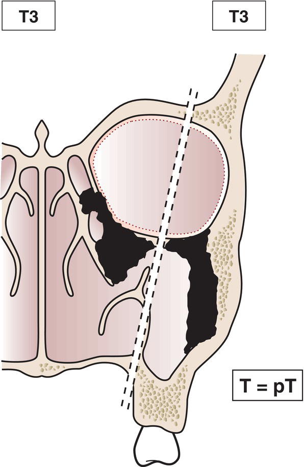 Schematic illustration of tumour invades any of the following: bone of posterior wall of maxillary sinus, subcutaneous tissues, floor or medial wall of orbit, pterygoid fossa, ethmoid sinuses.