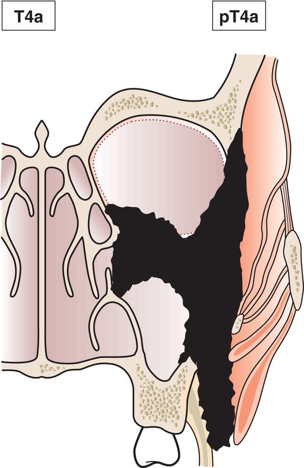 Schematic illustration of tumour invades any of the following: anterior orbital contents, skin of cheek, pterygoid plates, infratemporal fossa, cribriform plate, sphenoid or frontal sinuses.