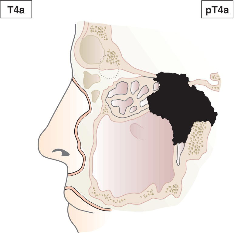 Schematic illustration of tumour invades any of the following: anterior orbital contents, skin of cheek, pterygoid plates, infratemporal fossa, cribriform plate, sphenoid or frontal sinuses.