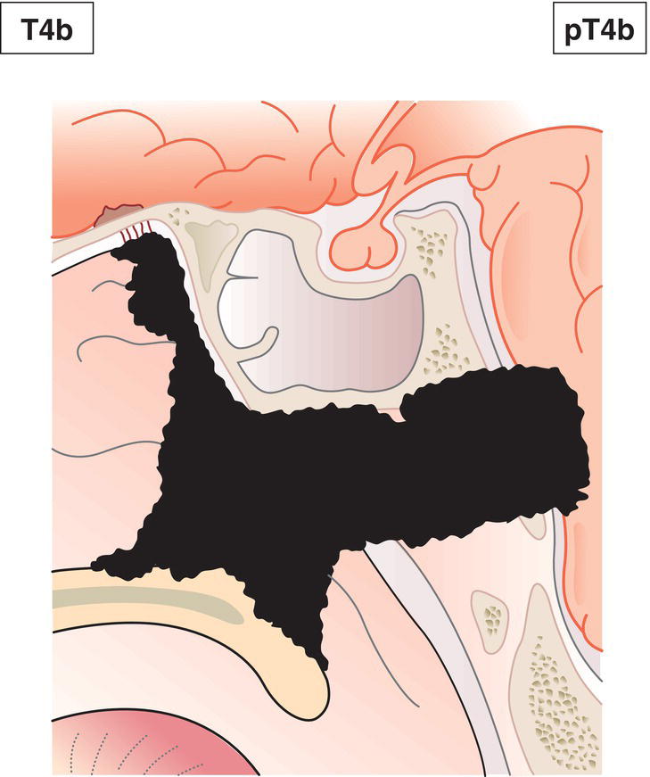 Schematic illustration of tumour invades any of the following: orbital apex, dura, brain, middle cranial fossa, cranial nerves other than maxillary division of trigeminal nerve (V2), nasopharynx or clivus.