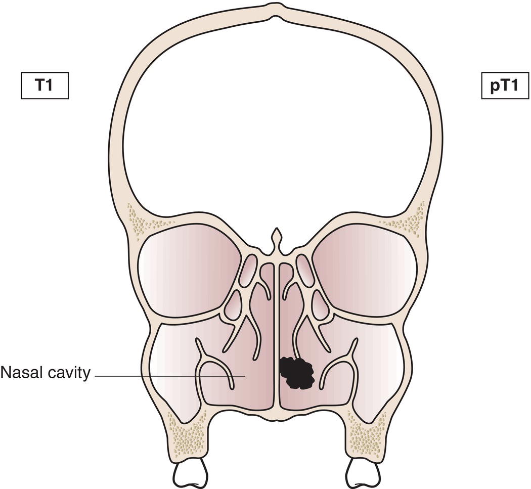 Schematic illustration of tumour restricted to one subsite of nasal cavity or ethmoid sinus, with or without bony invasion.