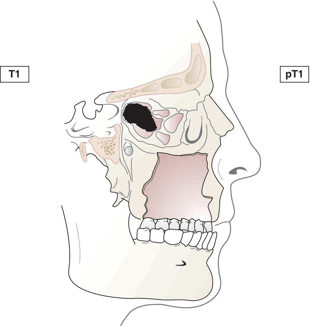 Schematic illustration of tumour restricted to one subsite of nasal cavity or ethmoid sinus, with or without bony invasion.