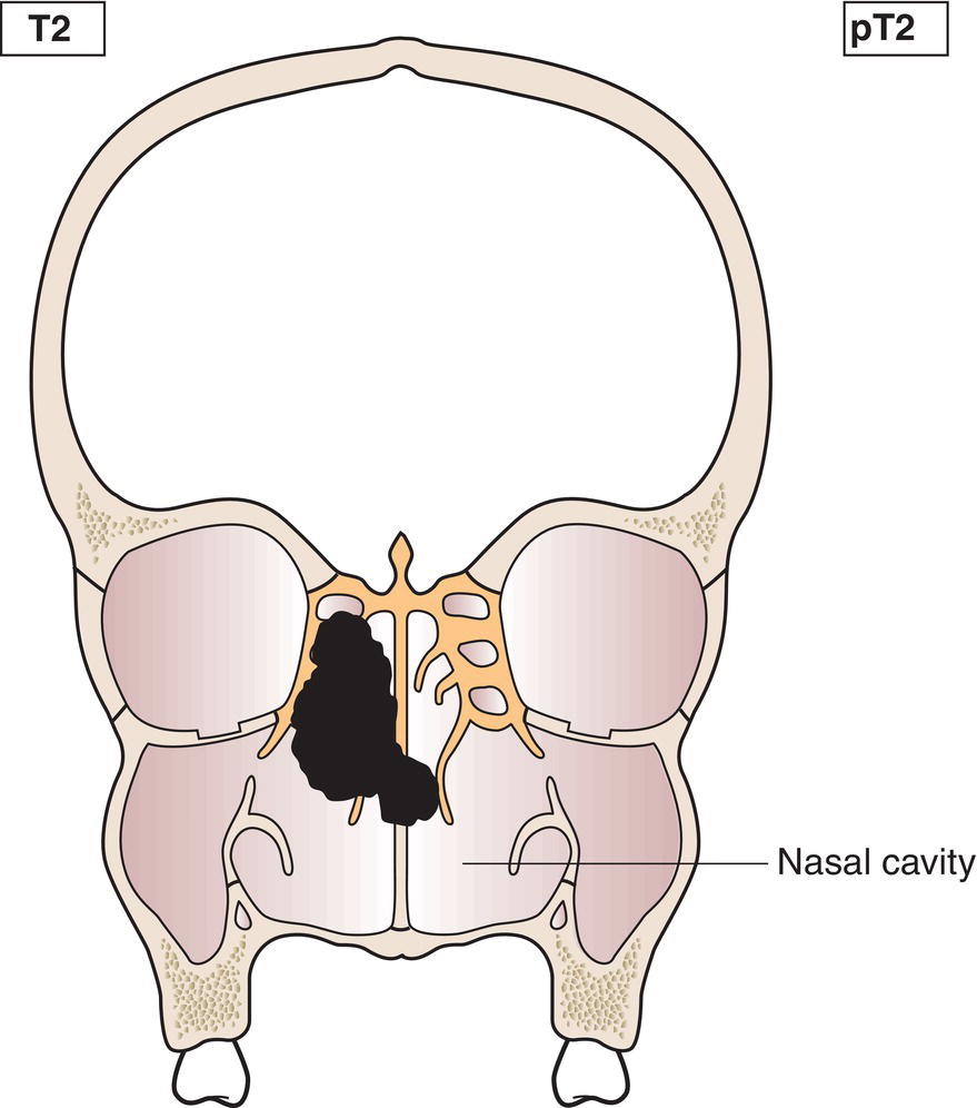 Schematic illustration of tumour involves two subsites in a single site or extends to involve an adjacent site within the nasoethmoidal complex, with or without bony invasion.