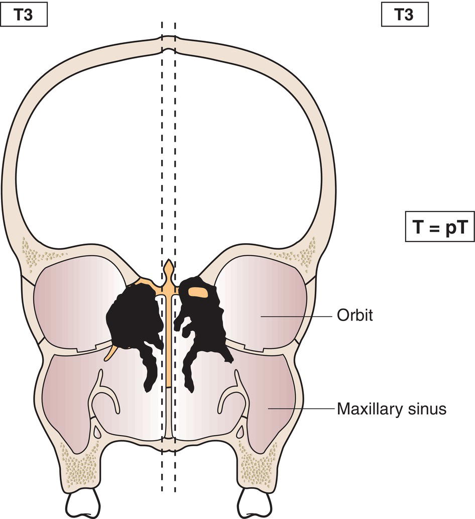 Schematic illustration of tumour extends to invade the medial wall or floor of the orbit, maxillary sinus, palate, or cribriform plate.