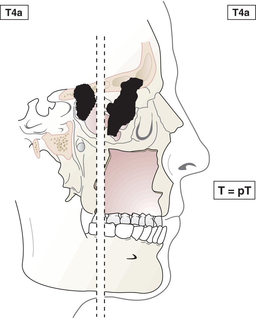 Schematic illustration of tumour invades any of the following: anterior orbital contents, skin of nose or cheek, minimal extension to anterior cranial fossa, pterygoid plates, sphenoid or frontal sinuses.