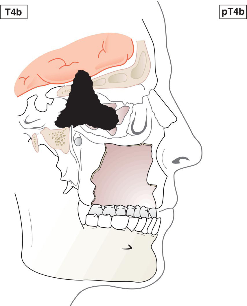 Schematic illustration of tumour invades any of the following: orbital apex, dura, brain, middle cranial fossa, cranial nerves other than V2, nasopharynx or clivus.