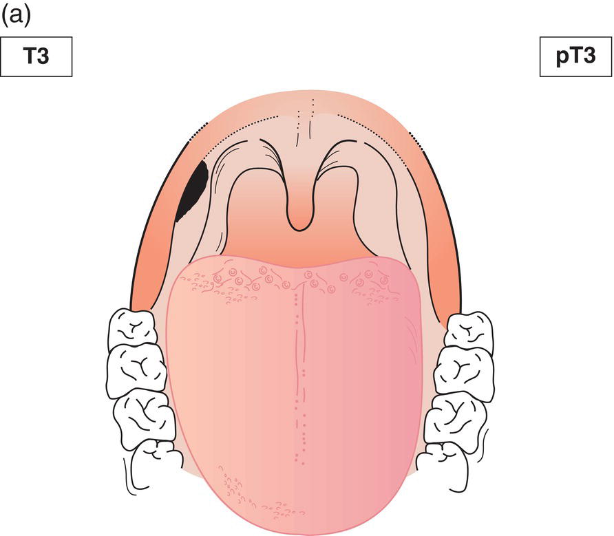 Schematic illustration of tumour limited to the epithelium and submucosa.