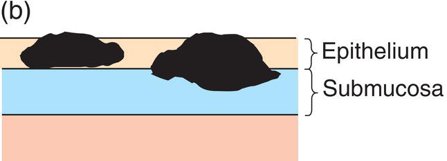 Photo depicts the Tumour limited to the epithelium and submucosa.