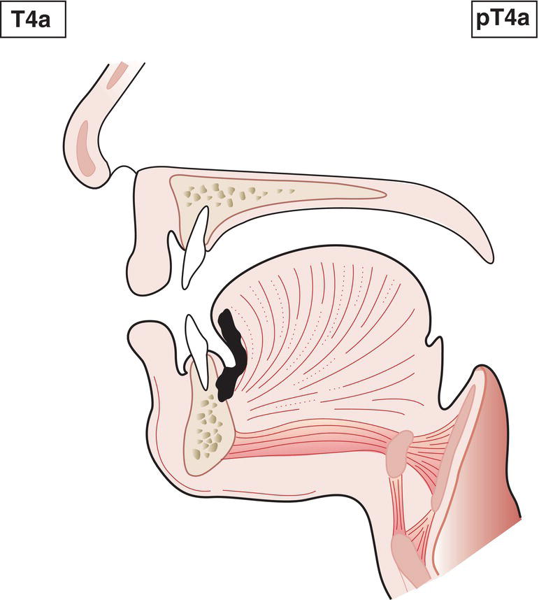 Schematic illustration of tumour invades deep soft tissue, cartilage, bone or overlying skin.