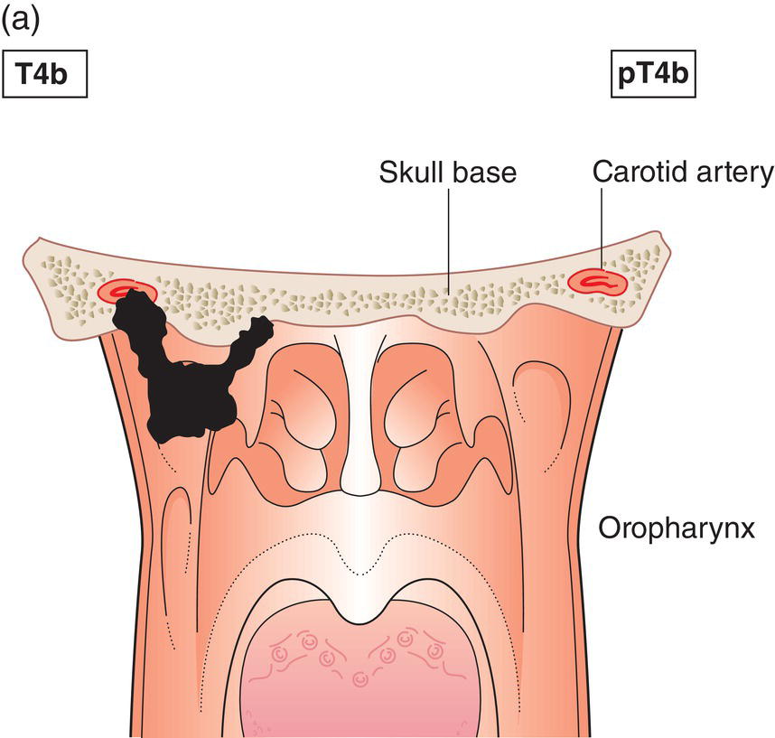 Schematic illustration of tumour invades any of the following: brain, dura, skull base, lower cranial nerves (IX, X, XI, XII), masticator space, carotid artery, prevertebral space, mediastinal structures.