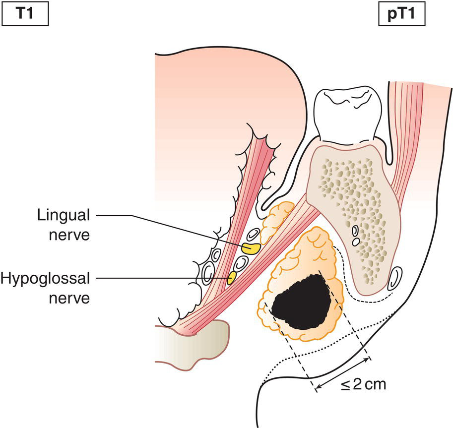 Schematic illustration of tumour 2 cm or less in greatest dimension without extraparenchymal extension.