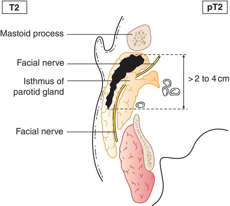 Schematic illustration of tumour more than 2 cm but not more than 4 cm in greatest dimension without extraparenchymal extension.