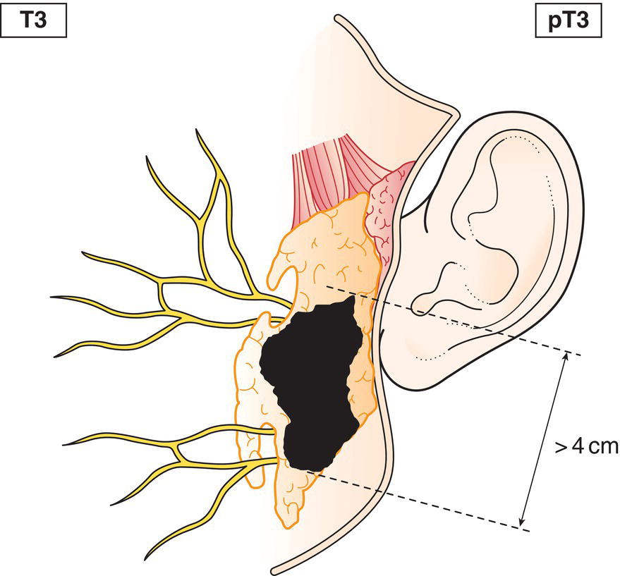 Schematic illustration of tumour more than 4 cm and tumour with extraparenchymal extension.