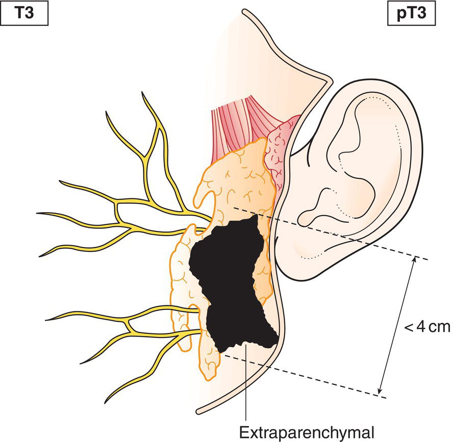 Schematic illustration of tumour more than 4 cm and tumour with extraparenchymal extension.