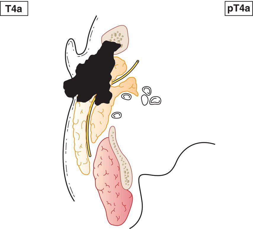 Schematic illustration of tumour invades skin, mandible, ear canal and facial nerve.