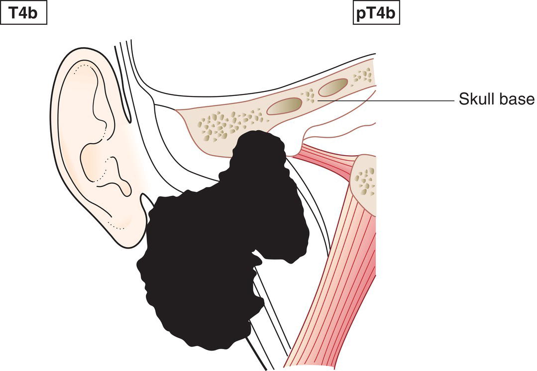 Schematic illustration of tumour invades base of skull, and pterygoid plates, and encases carotid artery.