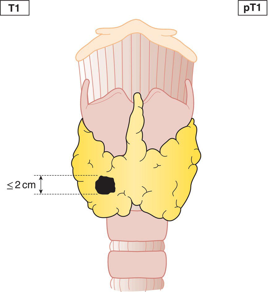 Schematic illustration of tumour 2 cm or less in greatest dimension, limited to the thyroid.