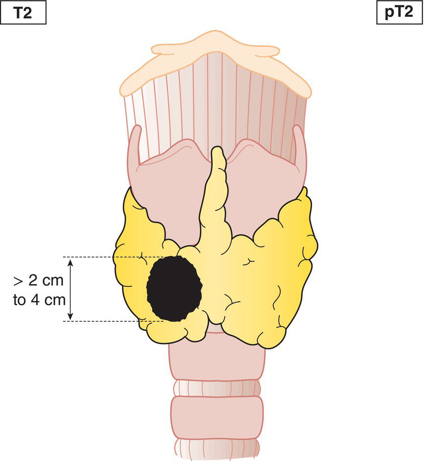 Schematic illustration of tumour more than 2 cm but not more than 4 cm in greatest dimension, minimal extrathyroidal extension.