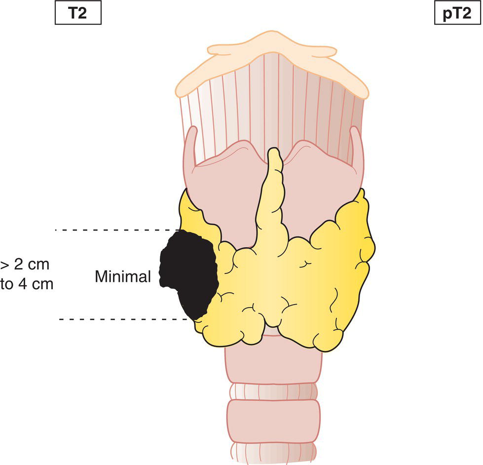 Schematic illustration of tumour more than 2 cm but not more than 4 cm in greatest dimension, minimal extrathyroidal extension may be present.