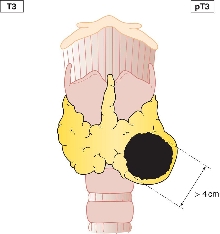 Schematic illustration of tumour more than 4 cm in greatest dimension, limited to the thyroid or with minimal extrathyroid extension.