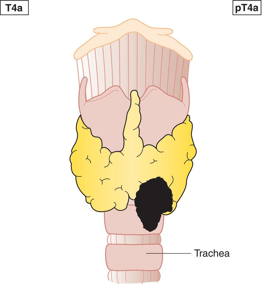 Schematic illustration of tumour extends beyond the thyroid capsule and invades subcutaneous soft tissues, larynx, trachea, oesophagus, recurrent laryngeal nerve.