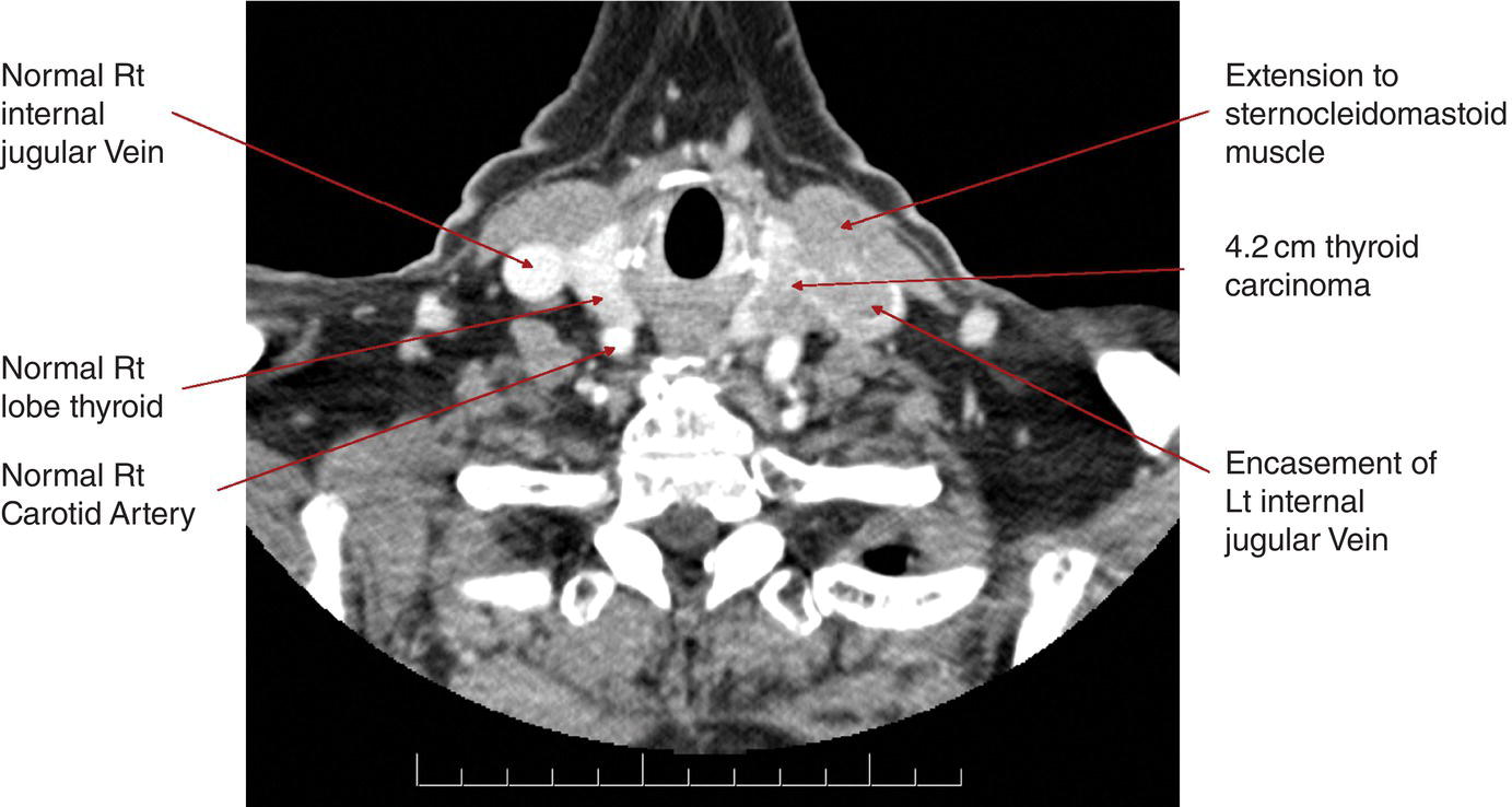 Photo depicts the Tumour extends beyond the thyroid capsule and invades subcutaneous soft tissues, larynx, trachea, oesophagus, recurrent laryngeal nerve.