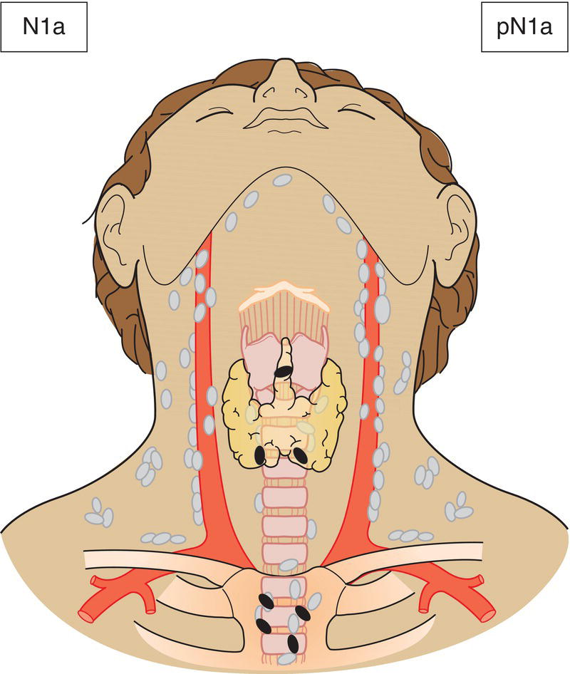 Schematic illustration of Metastasis in Level VI (pretracheal, paratracheal and prelaryngeal or Delphian lymph nodes) or upper or superior mediastinum.