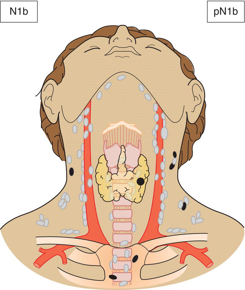 Schematic illustration of Metastasis in other unilateral, bilateral or contralateral cervical (Levels I, II, III, IV or V) or retropharyngea.