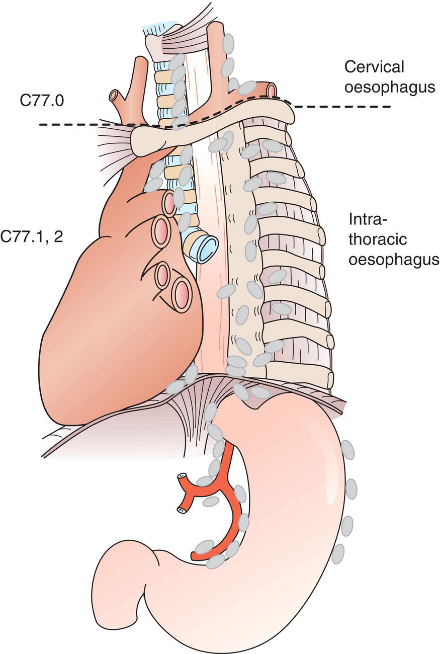 Schematic illustration of Regional Lymph Nodes.