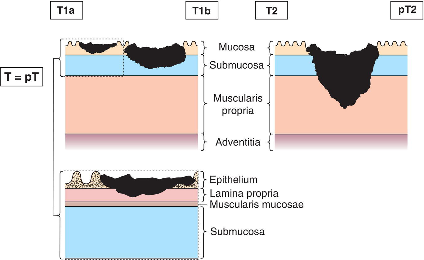 Photo depicts a Tumour invades muscularis propria.