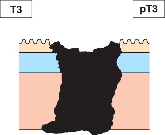 Photo depicts a Tumour invades adventitia.