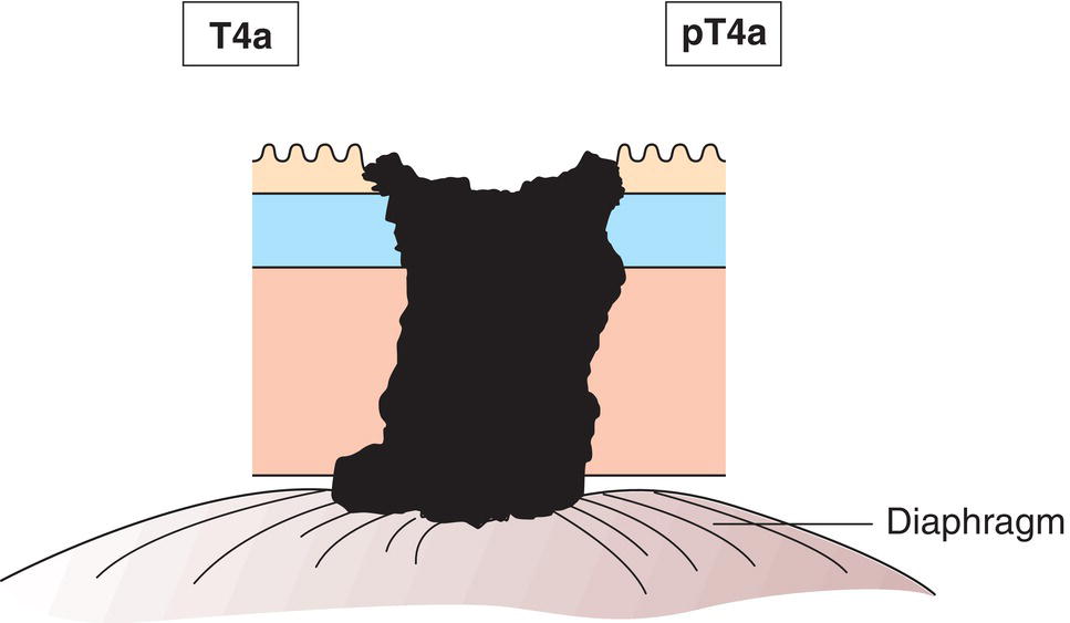 Photo depicts a Tumour invades adjacent structures.